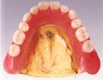ゴールドの総義歯