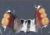 コバルトクロムの部分義歯