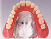 チタンの総義歯