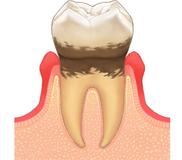 歯周病治療